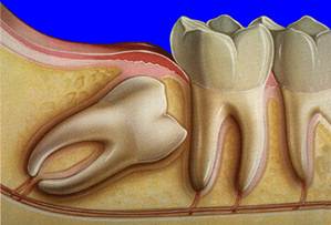 Зуб мудрости