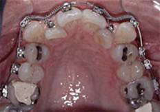 Брекет-система на верхней челюсти