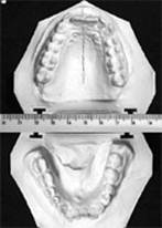 гипсовые модели челюстей