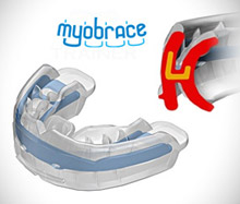 Myobrace