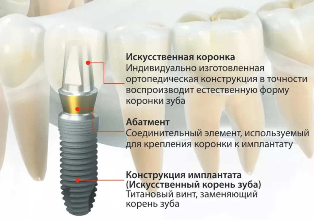 Строение импланта
